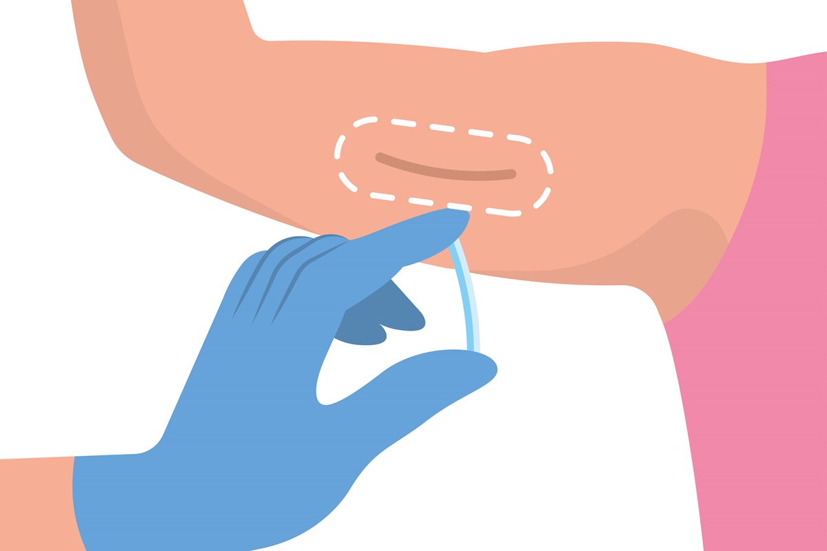 Ilustração colorida de implante contraceptivo hormonal (implanon) - Metrópoles