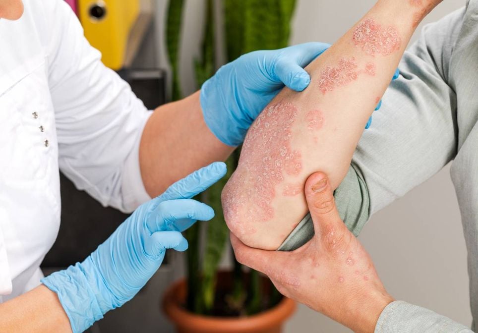 médica analisando braço de paciente com psoríase