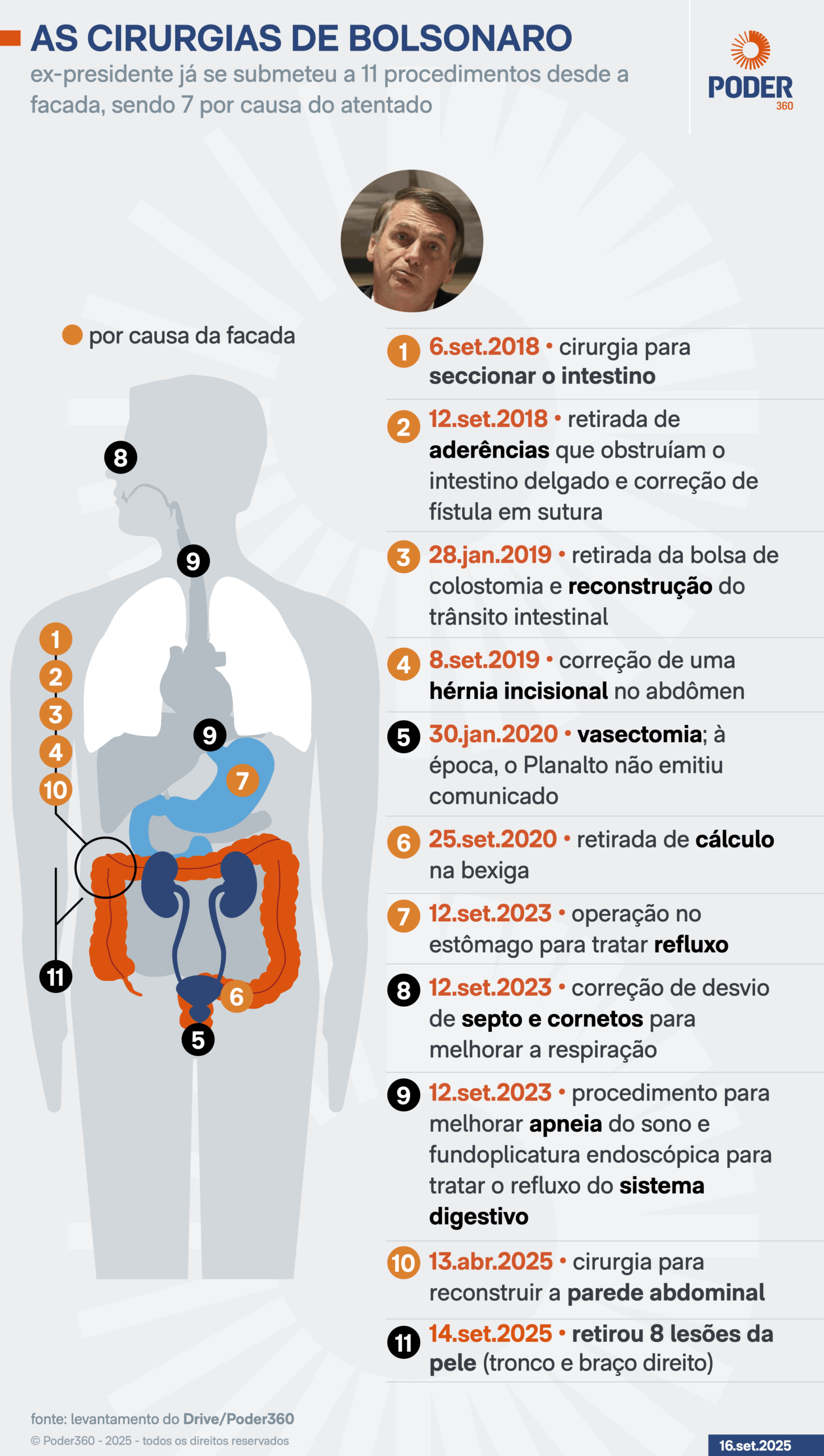 Infográfico mostra as cirurgias de Bolsonaro.