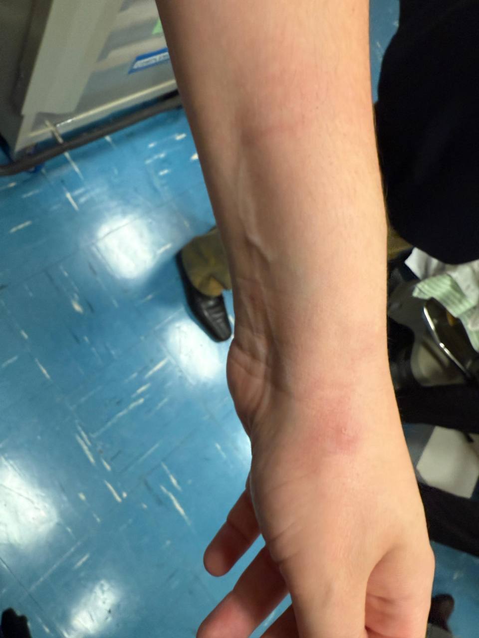 Deputada Sâmia Bonfim exibe hematomas no braço após confusão na Câmara | Arquivo Pessoal/Sâmia Bonfim