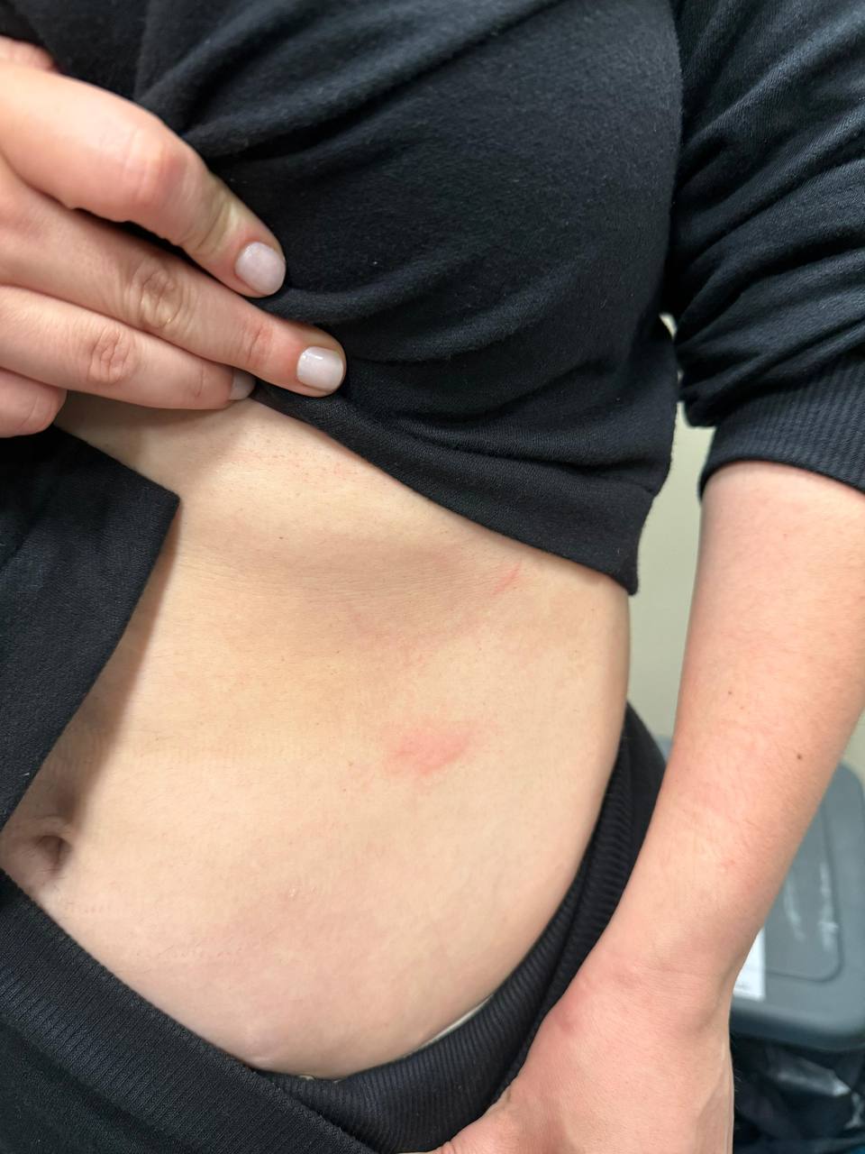 Sâmia Bonfim exibe hematomas na barriga após confusão na Câmara | Arquivo pessoal/Sâmia Bonfim