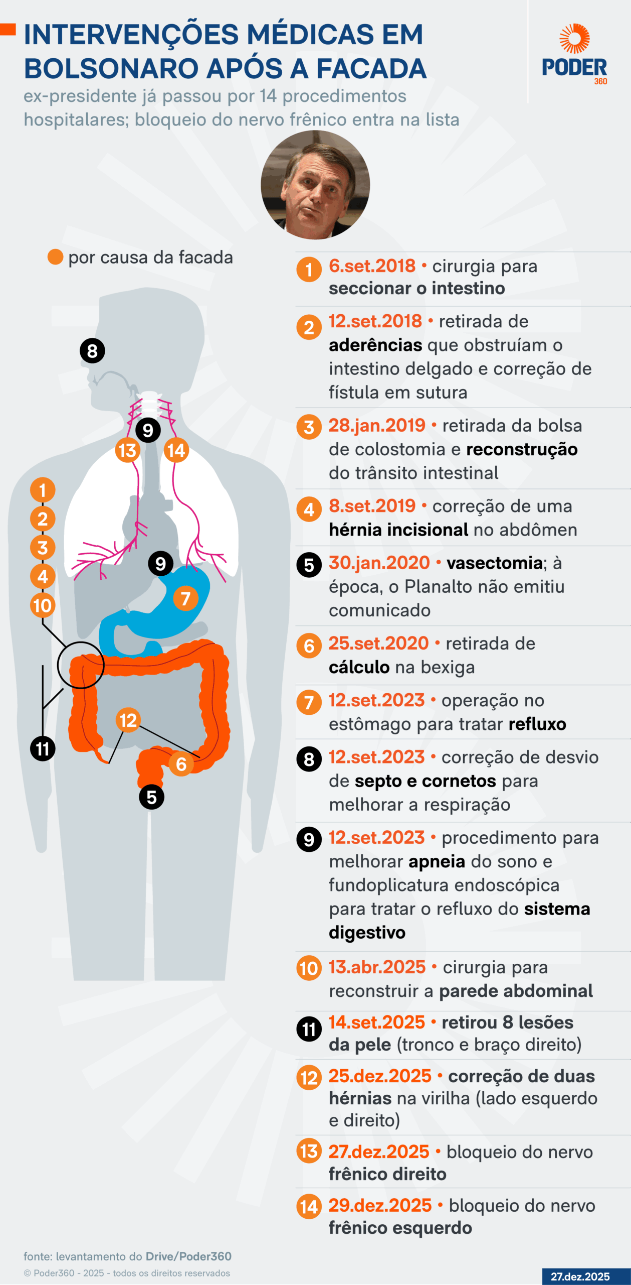 Infográfico mostra intervenções médicas em Bolsonaro após a facada